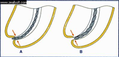 patencia apical endodontia.